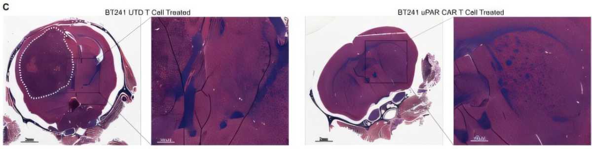 Brain Cancer Treatment Shows Promise with New Immunotherapy