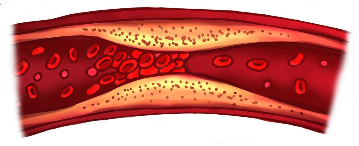 Genetic Research Could Help Patients Avoid Amputations