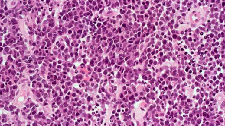 STAT+: BeOne Wins FDA Approval for Lymphoma Treatment