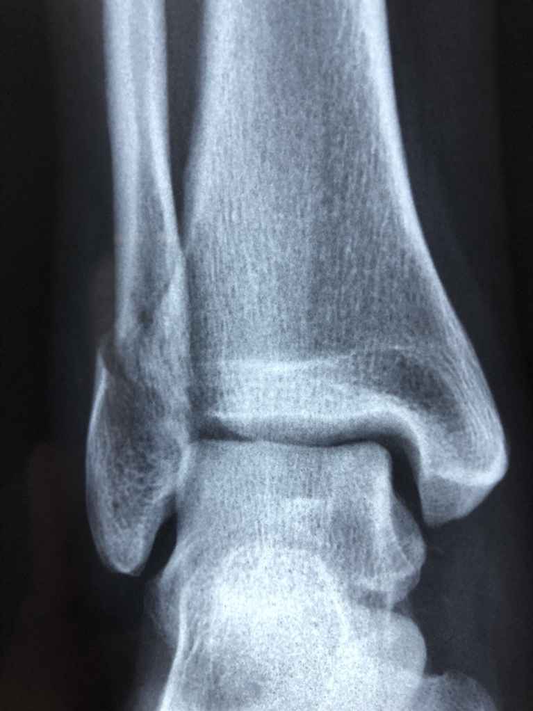 Drug Trial Challenges Long-held Beliefs on Brittle Bone Disease Treatment