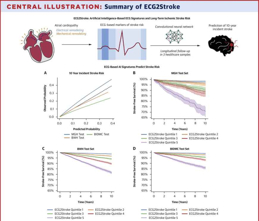 AI Model Predicts Stroke Risk Using Routine Cardiology Test
