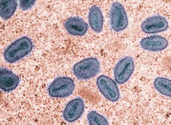 Mpox Study Reveals Hidden Infections May Fuel Spread