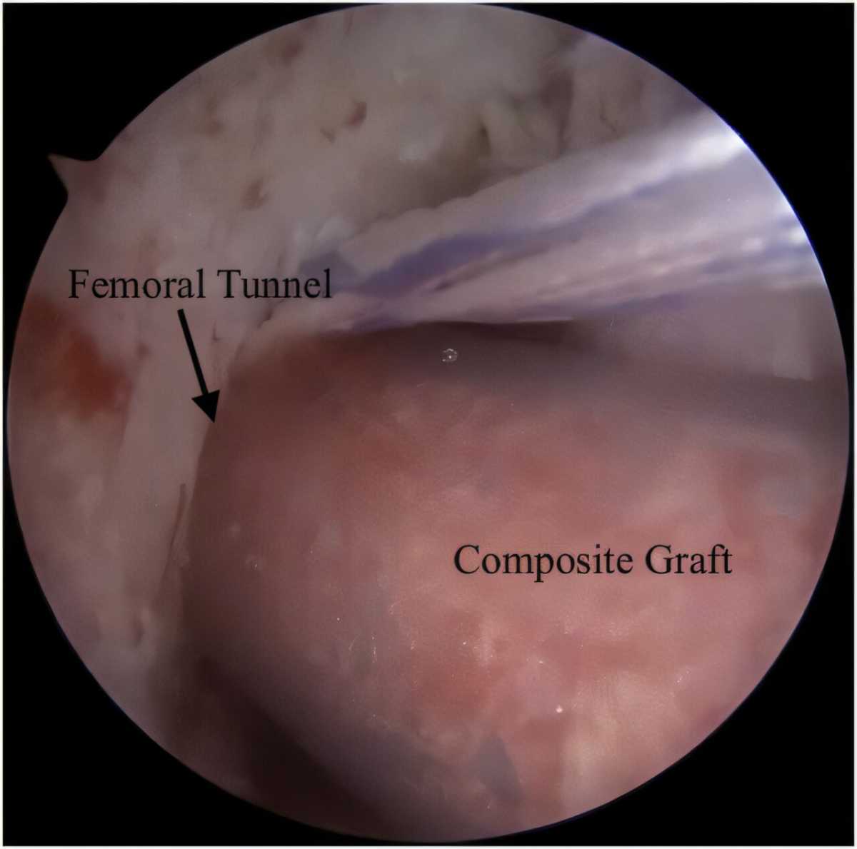 New ACL Surgery Approach Helps Most Patients Return to Activity