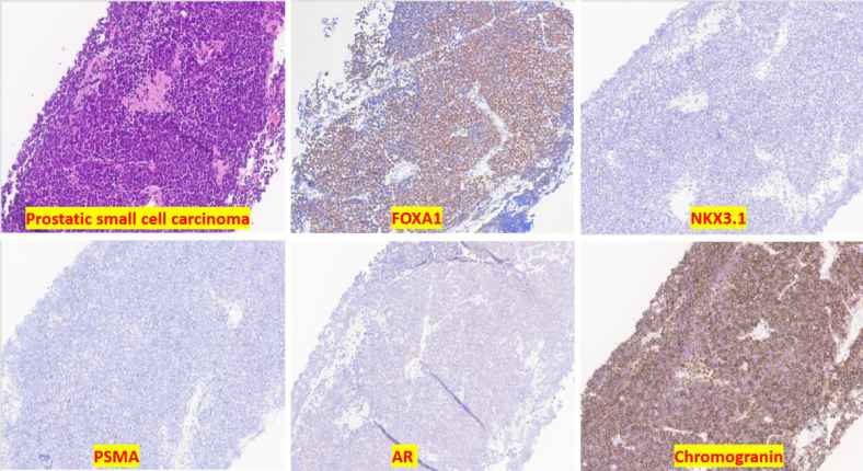 Diagnostic marker aids diagnosis for aggressive prostate cancer