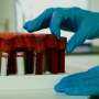 Blood Test Detecting Tumor DNA May Guide Cancer Treatment