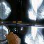 When should you get a mammogram? Conflicting advice makes it hard to know