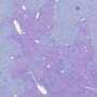 Why Only Some Patients Get Liver Disease: New Protein Pathway May Forecast Alpha1-Antitrypsin Outcomes