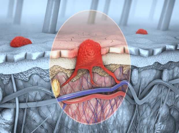 Microbiotica reports positive results for MB097 in advanced melanoma