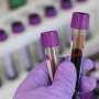 New Approach Could Lead to Earlier Diagnosis of Iron Deficiency in School-Aged Children