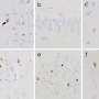Why does ALS pathology spread differently among patients?