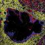 Study Sheds Light on Pancreatic Lesions Becoming Cancer