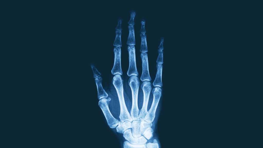 STAT+: Immunovant Shares Surge on Arthritis Trial Data