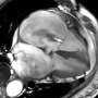 MRI technique enhances valve disease evaluation