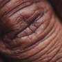 Dermatologists and oncologists call for overhaul of widely used cancer side-effect grading system