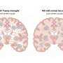 Overloaded brain cleanup cells may mark severe multiple sclerosis progression and indicate potential treatment targets