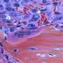 Cholesterol-craving cancers need lipid enzymes to use metabolites for growth, study shows