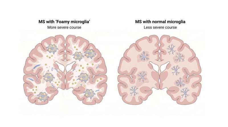 Overloaded brain cleanup cells may mark severe multiple sclerosis progression and indicate potential treatment targets