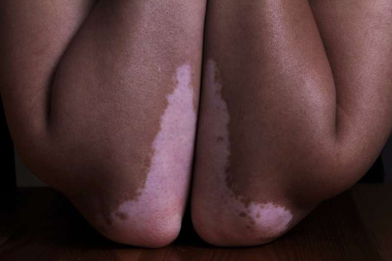 Vitiligo Affects One in 100 Worldwide, Yet Condition Remains Misunderstood