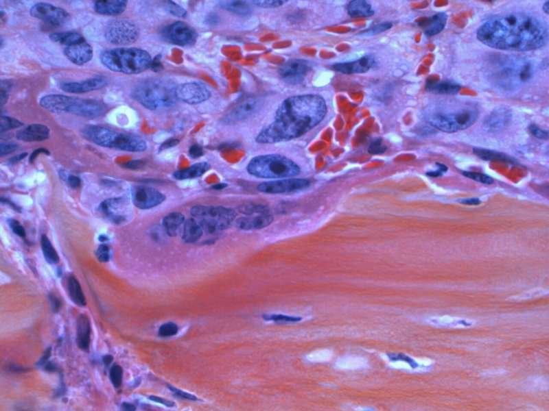 Cholesterol-craving cancers need lipid enzymes to use metabolites for growth, study shows