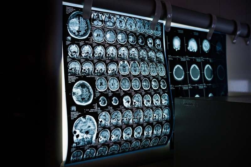 Duration of depression may influence how severely the disease alters the brain
