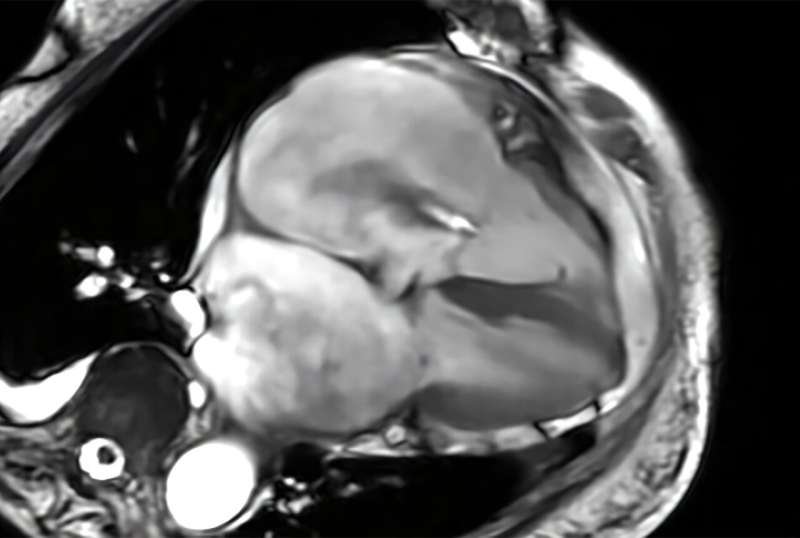 MRI technique enhances valve disease evaluation