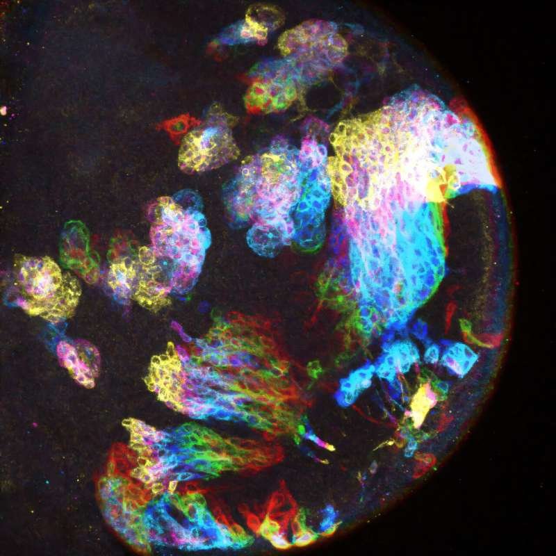 Brain's 'tumor hotspots' uncovered in fruit fly study