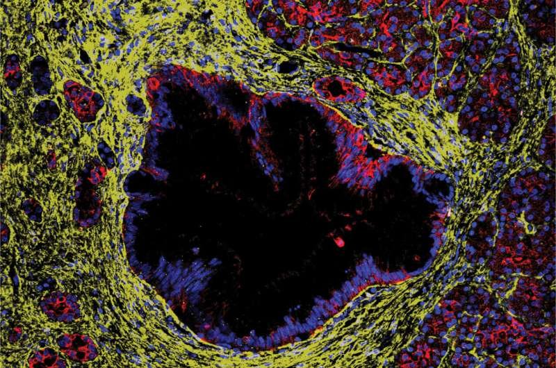 Study Sheds Light on Pancreatic Lesions Becoming Cancer