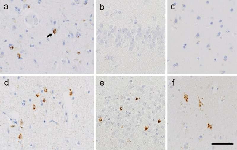 Why does ALS pathology spread differently among patients?