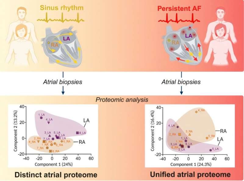 Both Heart Chambers Affected More Severely in Persistent Atrial Fibrillation Study Finds