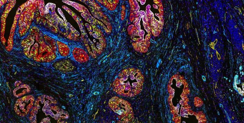 Keratin 17 drives resistance in pancreatic cancer, study finds