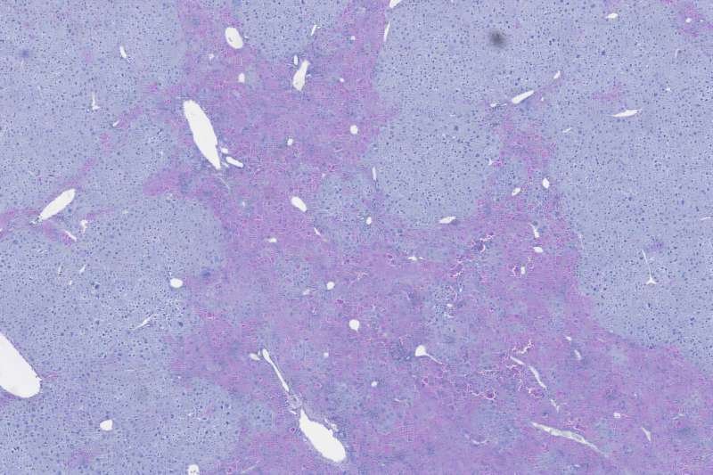 Why Only Some Patients Get Liver Disease: New Protein Pathway May Forecast Alpha1-Antitrypsin Outcomes