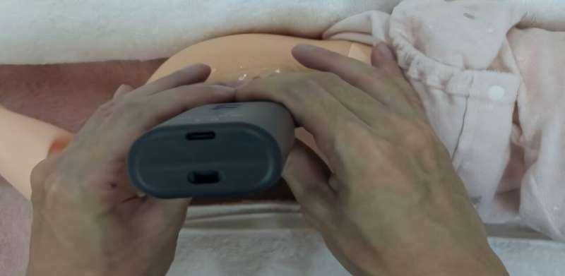 Community-based baby hip screening successfully reduces late diagnosis of developmental dysplasia