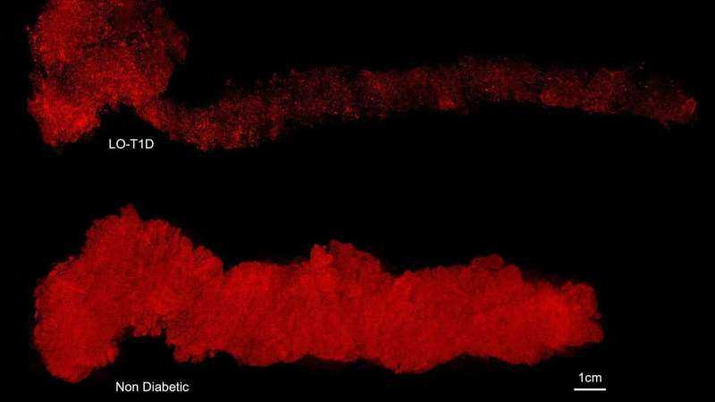 Whole Organ 3D Imaging Reveals Remaining Insulin-Producing Cells in Type 1 Diabetes