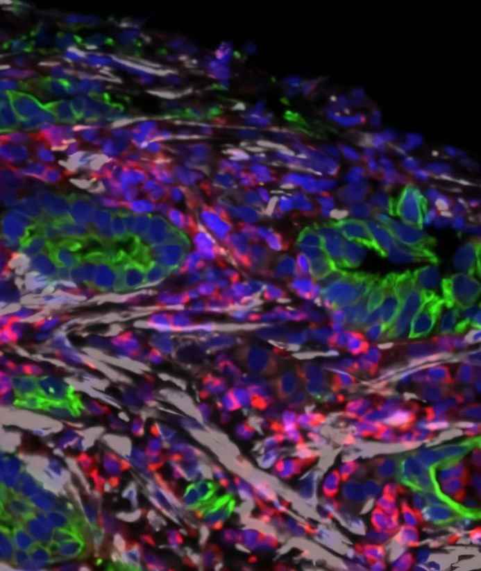 Vitamin D Analog Shows Promise in Shaping Pancreatic Cancer Environment