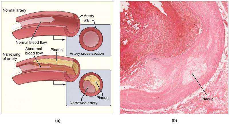 New Study Reveals Role of Inflammation in Artery Plaque Formation and Potential Therapeutic Target
