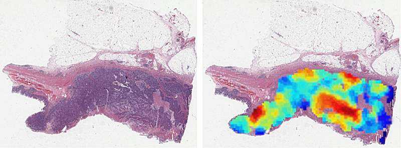 New AI Model Accelerates Colorectal Cancer Analysis at University of Jyväskylä