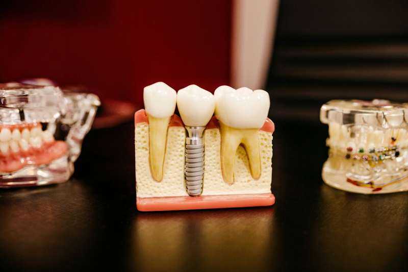 Titanium particles may explain why antibiotics fail against dental implant infections, affecting millions of patients worldwide