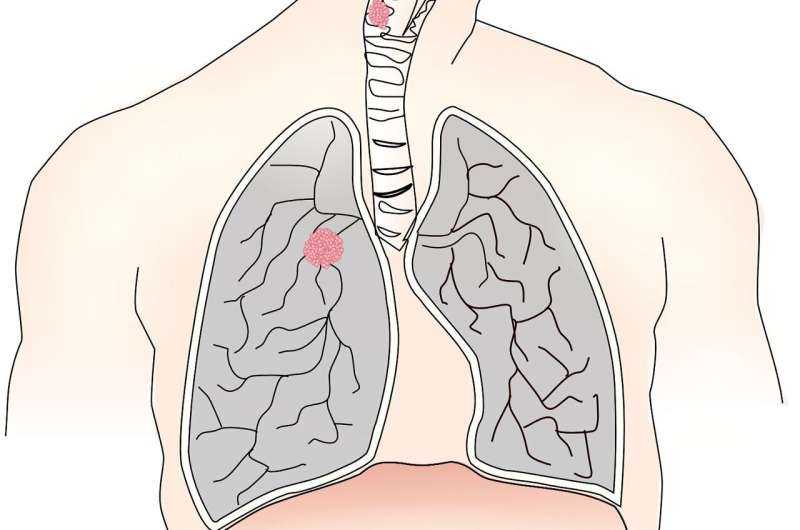 Lung Cancer Patients Who Smoke Pre-Surgery Still Have Positive Outcomes, Study Shows