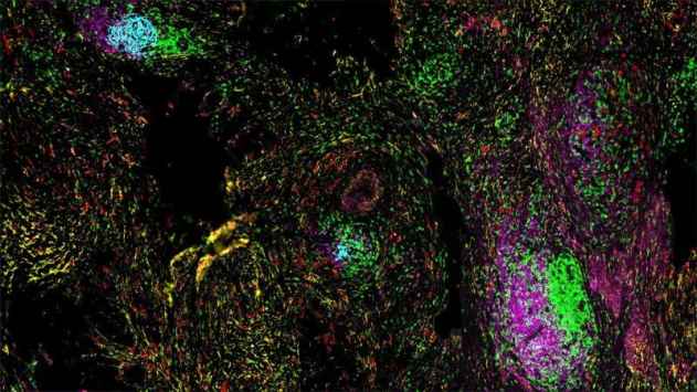 AI-powered atlas reveals new insights into tertiary lymphoid structures as prognostic and response biomarkers in cancer