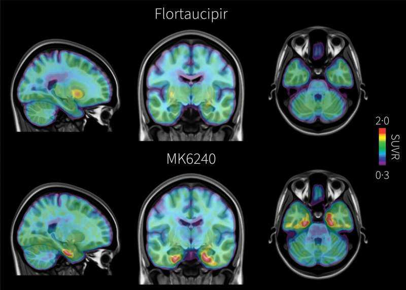 Researchers Develop New Brain Scan to Detect Alzheimer's Tau Protein Earlier