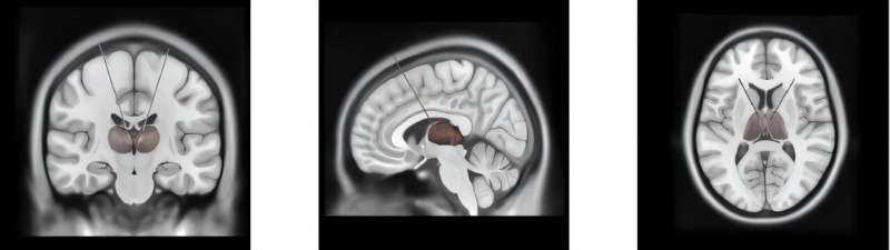Neuropsychologists Unveil Brain Rhythm Linked to Conscious States
