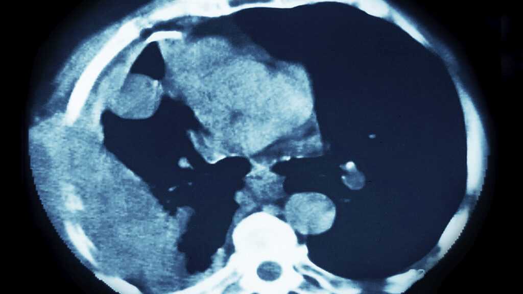 Akeso and Summit’s Ivonescimab Extends Survival in Squamous Cell Lung Cancer