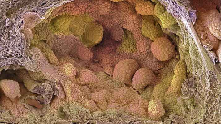 For High-Risk Prostate Cancer Patients, New Hormone Regimen May Improve Surgical Outcomes