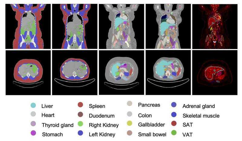 PET Imaging Reveals Whole-Body Metabolic Changes Post-Bariatric Surgery