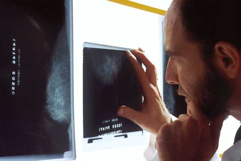 AI System Accurately Diagnoses Breast Cancer