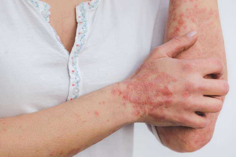 Newest medicines work just as well at half dosage for stable psoriasis, new study finds