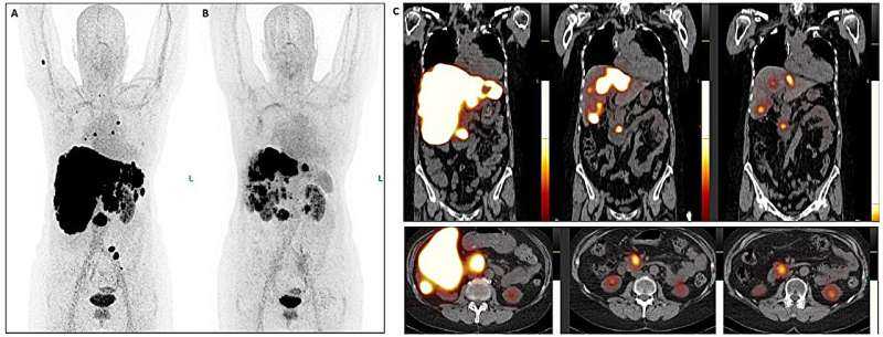 Novel radiopharmaceutical therapy offers powerful treatment option for aggressive neuroendocrine tumors