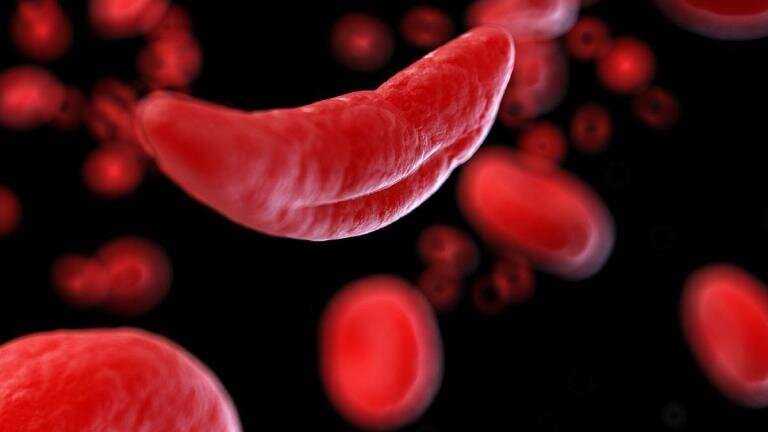 Stem Cell Transplantation Proven More Cost-Effective than Gene Therapy for Sickle Cell Disease