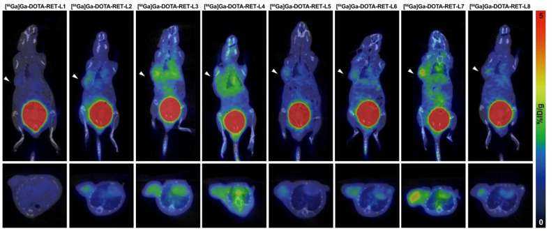 New Theranostic Approach Targets RET Biomarker for Effective Neuroendocrine Prostate Cancer Treatment