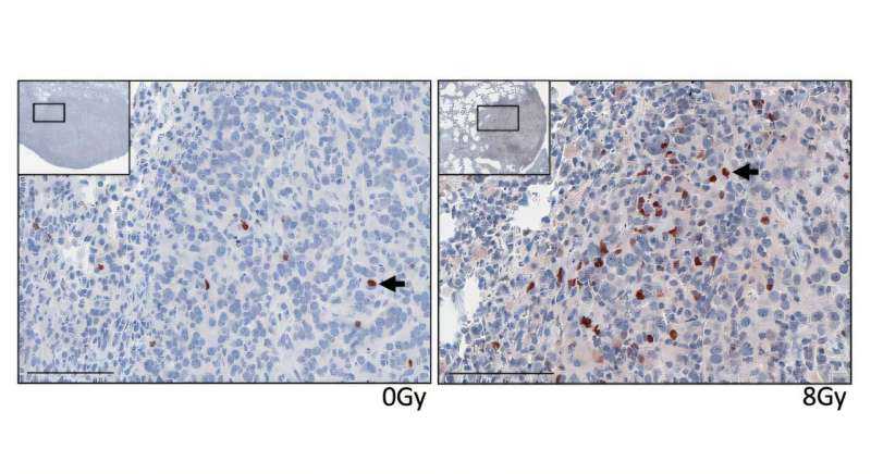 Irradiation May Help CAR-T Cell Therapy Work Better Against Solid Tumors